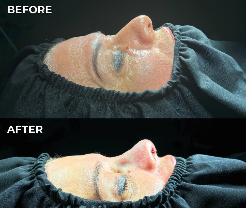 Before and After Result